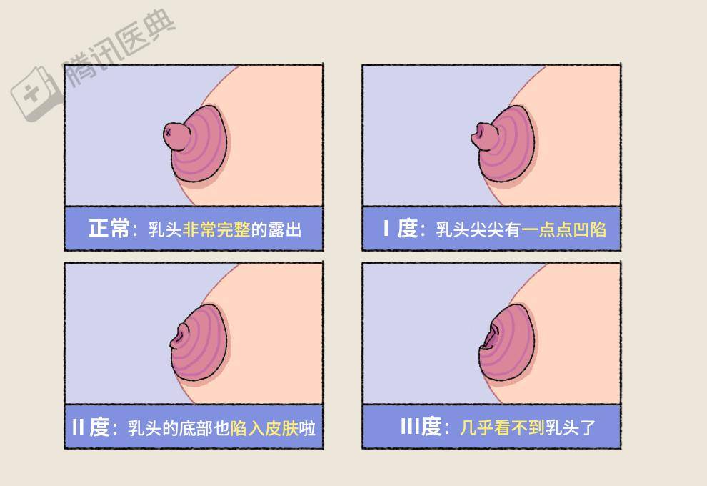 乳头这5种变化,真的不用担心!