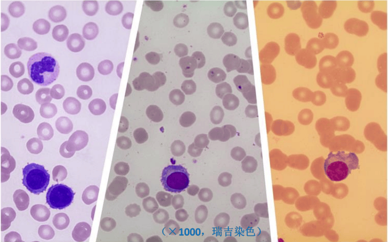 【病例分享】异常形态浆细胞白血病