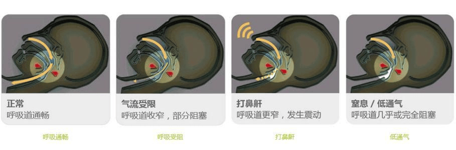 名医话健康 | 家有“呼噜娃”该怎么办?_睡眠_儿童_治疗