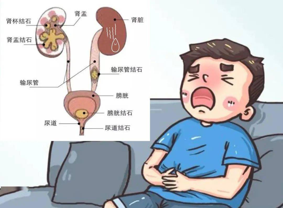 打破束缚 让结石无处可"逃"