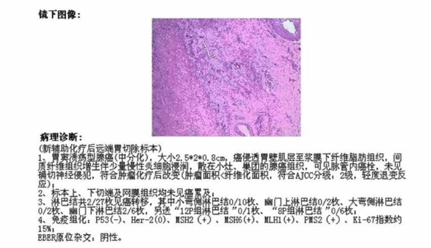 胃癌病理报告单图片图片