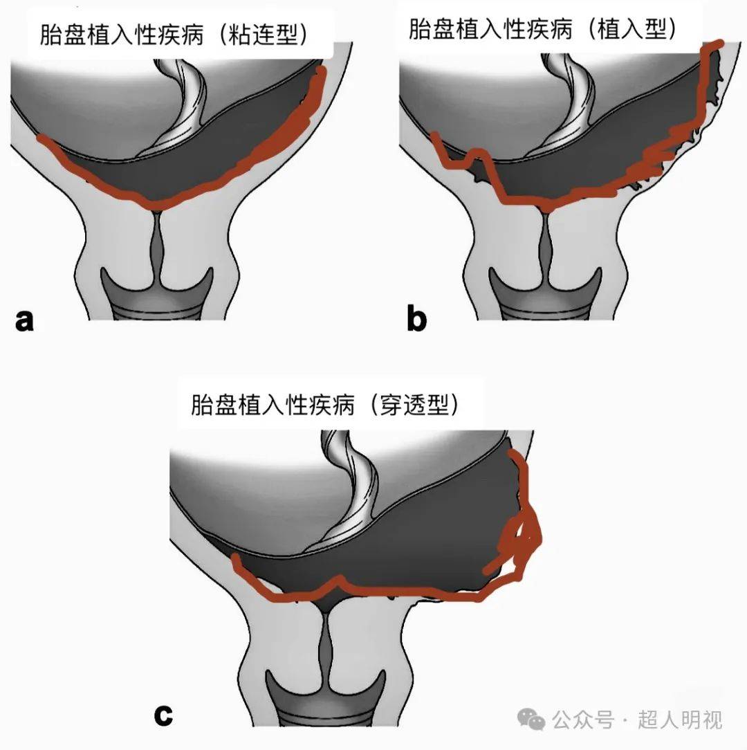 前置胎盘图解图片