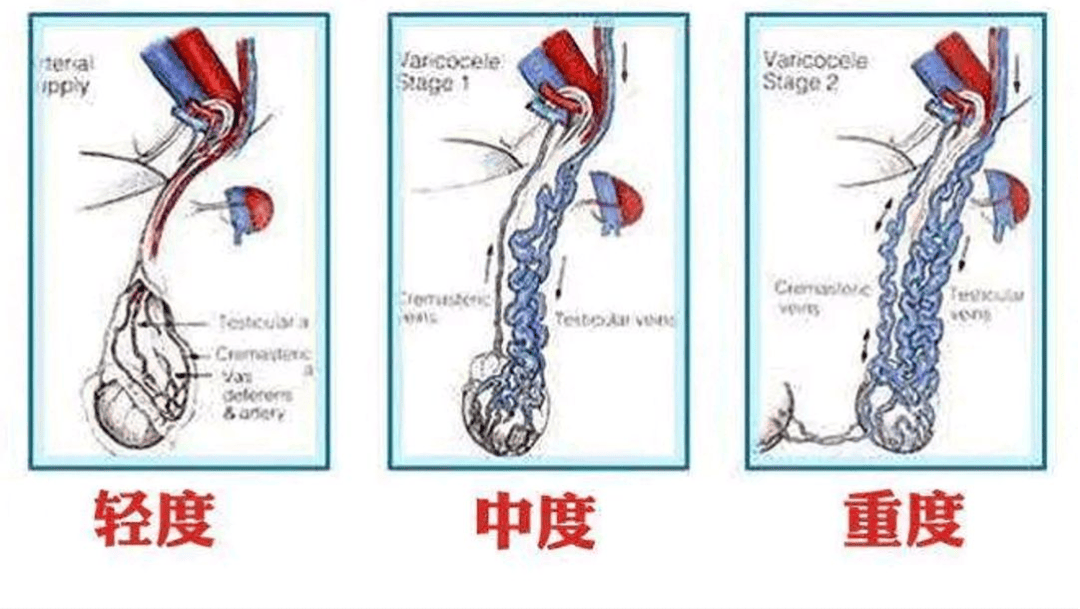 精索图片正常图片图片