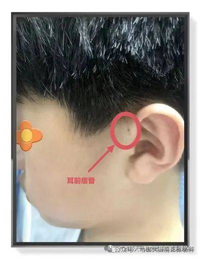 先天性耳前瘘管位置图图片