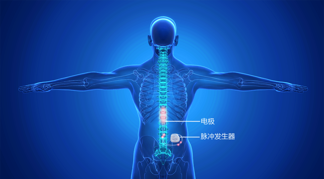 唤醒沉睡:郑州大学五附院脊髓电刺激术成就生命奇迹