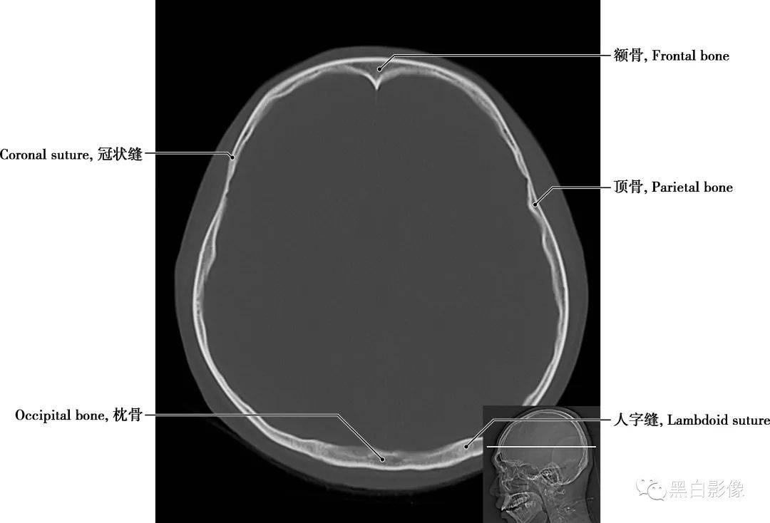 颞叶钩回疝ct解剖图片