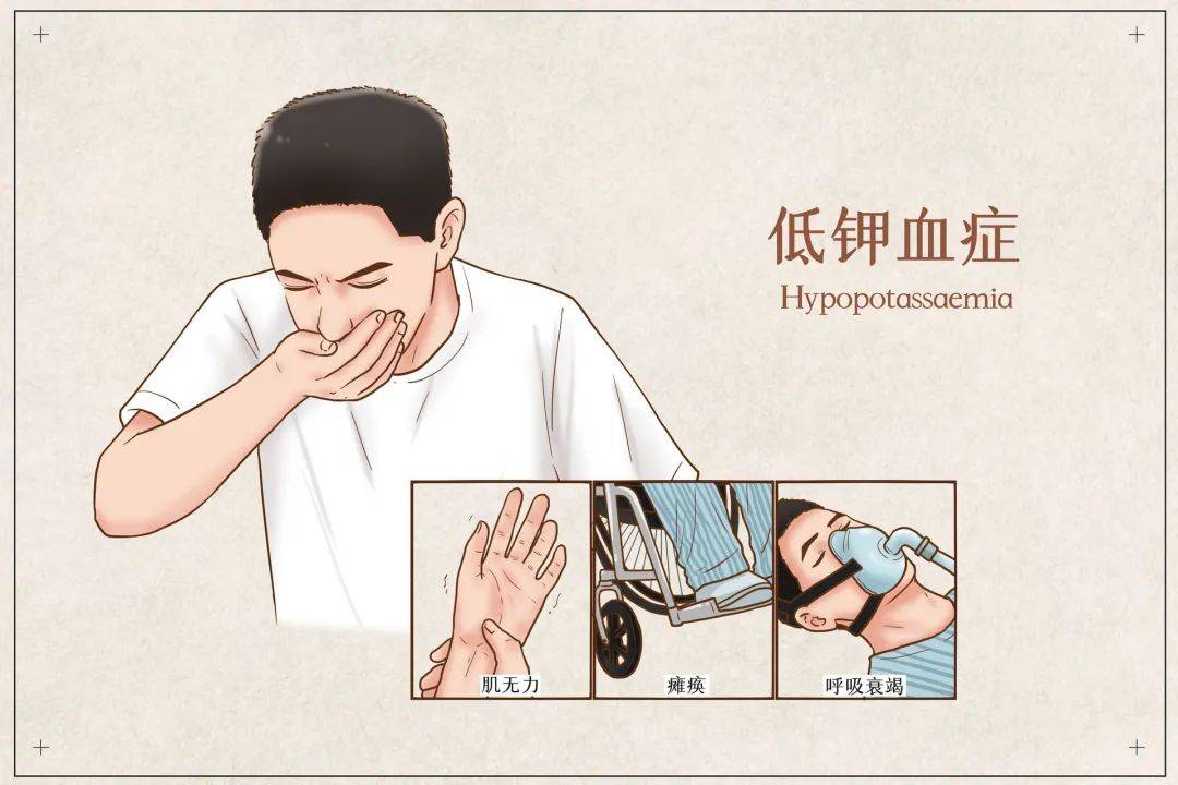 低钾血症会有哪些症状？① 肌肉表现：病人常感疲乏、软弱、乏力，严重时