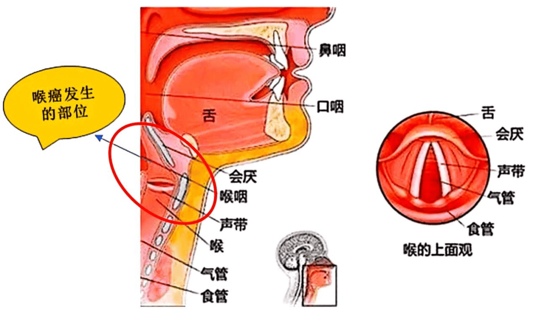 喉癌位置图图片