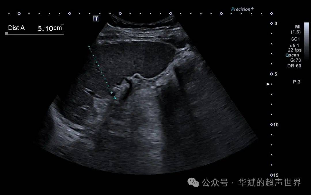 典型病例61必要的扩大范围扫查还是很重要的_检查_综合征_超声