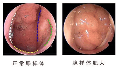 唾液腺增生图片