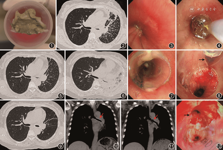 支气管镜下病变图谱图片