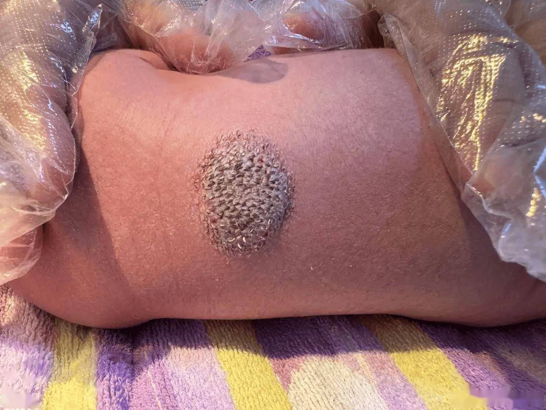 背上这团「小刺猬」究竟是啥?