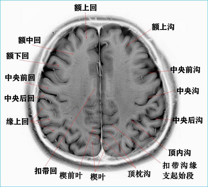 脑干mri断层解剖图图片