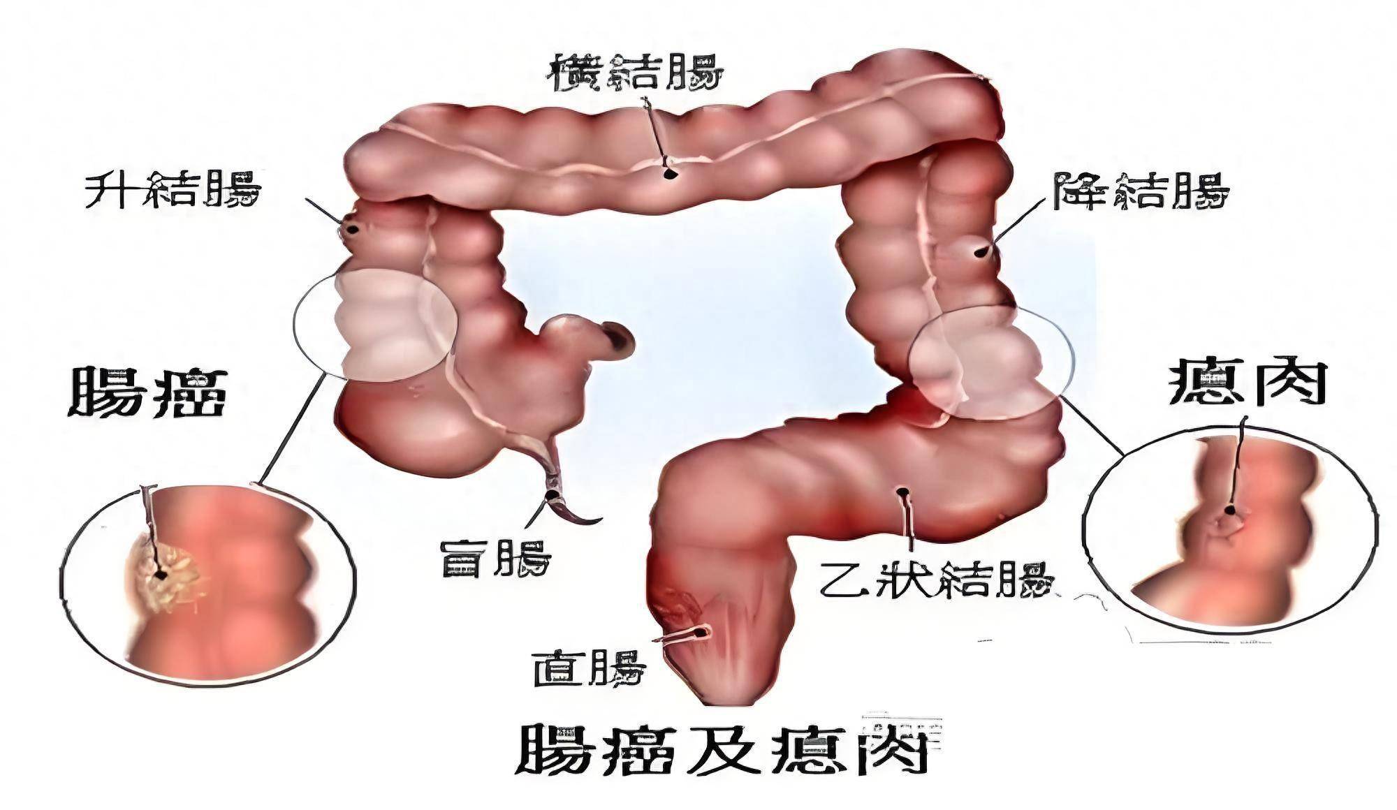 结肠癌患者在饮食上应该注意什么?