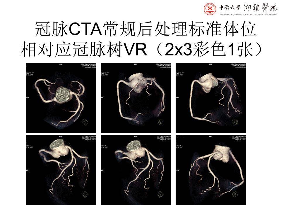 心脏造影图解析图片