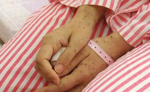 【妇幼新闻】孕妇临产遇上水痘,幸好遇到了他们