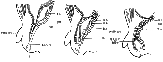 男宝宝疝环口位置图片图片