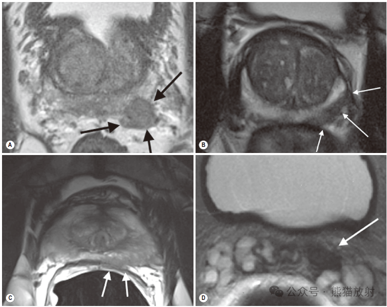 前列腺磁共振正常图像图片