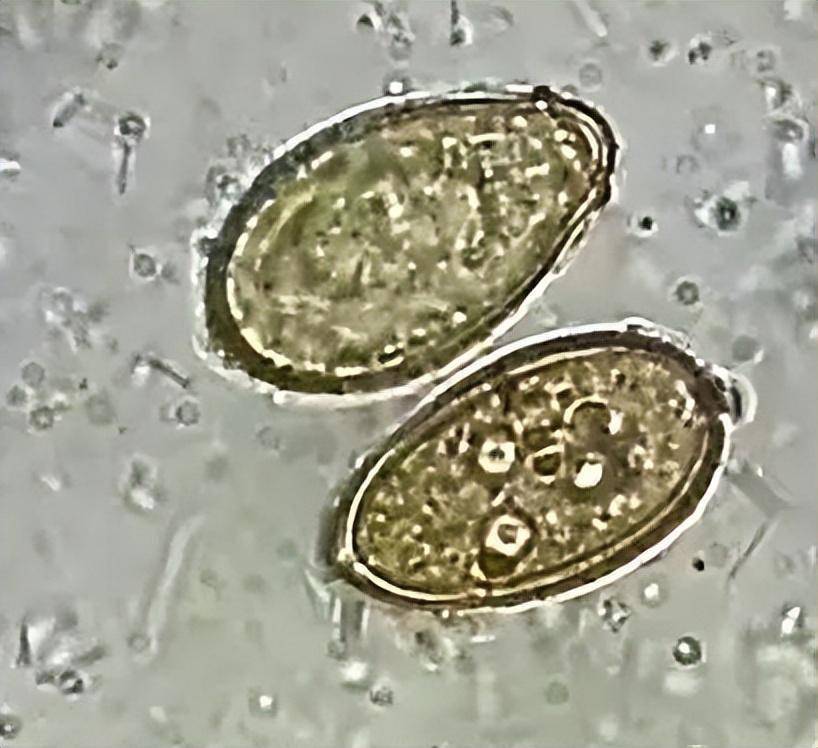高清肝包虫图片 虫卵图片