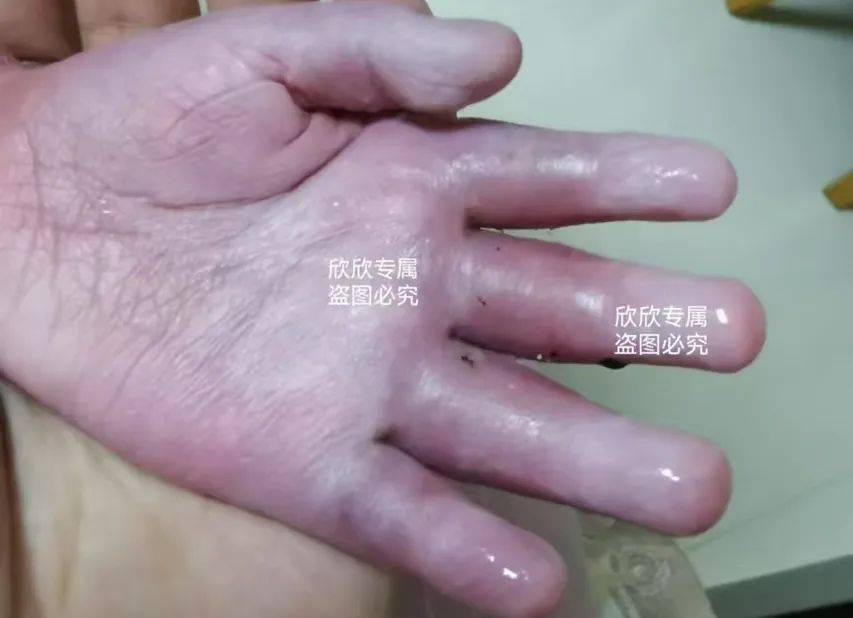 2岁女童手指险遭截肢,只因大人这个疏忽!医生:有娃家庭一定要重视