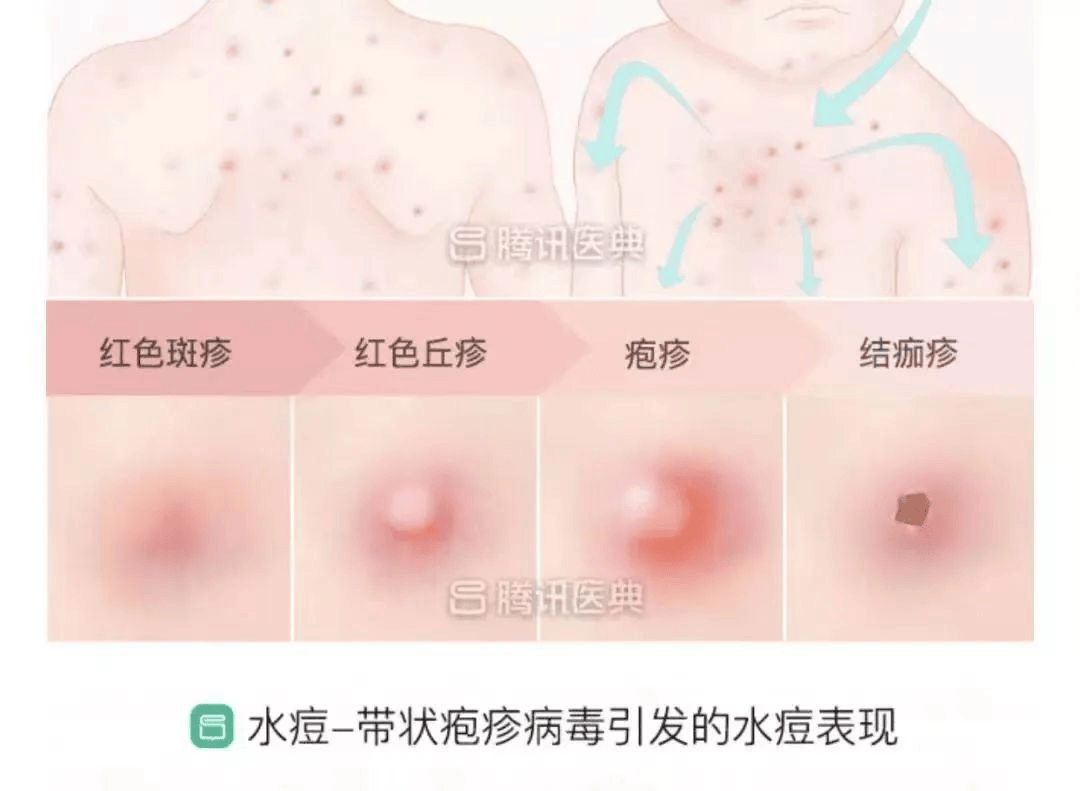 水痘的过程图片图片