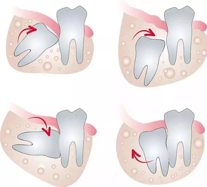智齿是哪一颗牙齿图图片