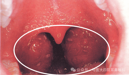 扁桃体隐窝凸起小肉芽图片