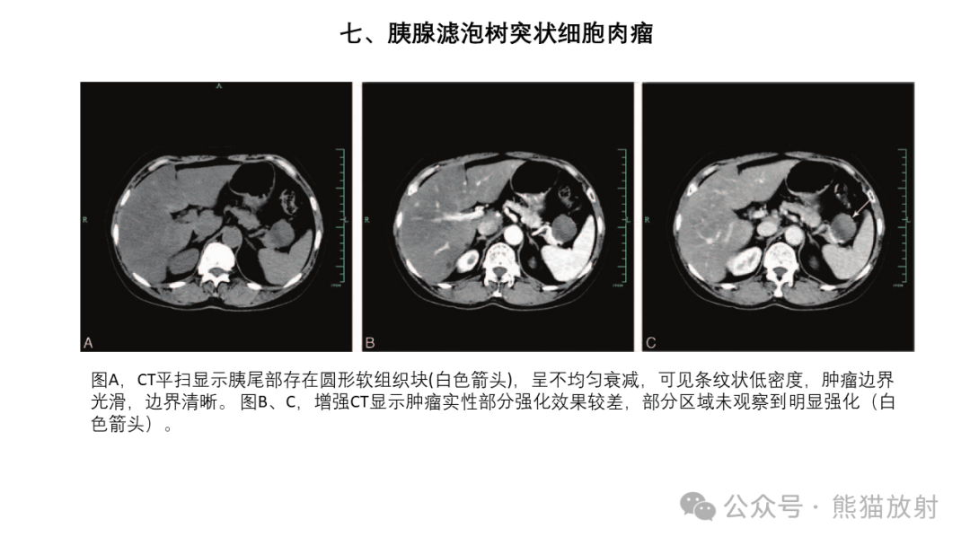 胰腺结节图片