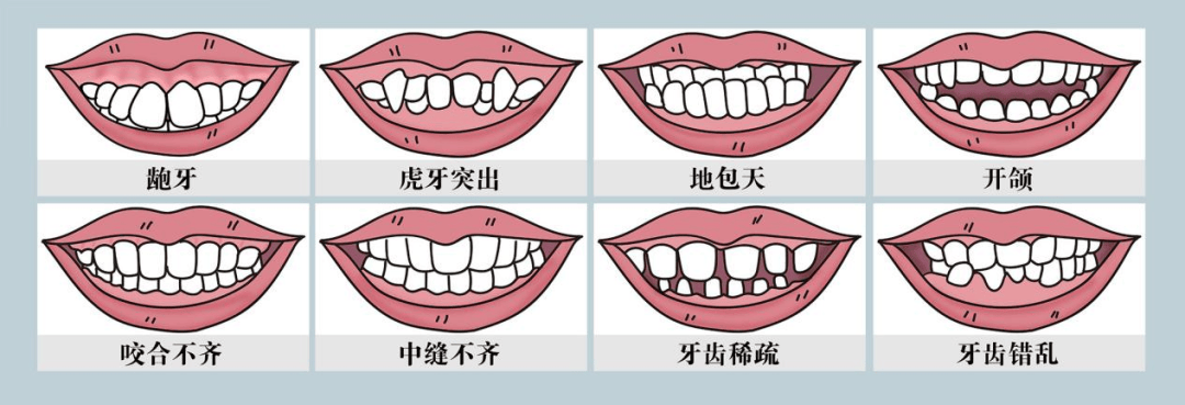 78前牙深覆盖(龅牙,凸面型),前牙深覆颌(或
