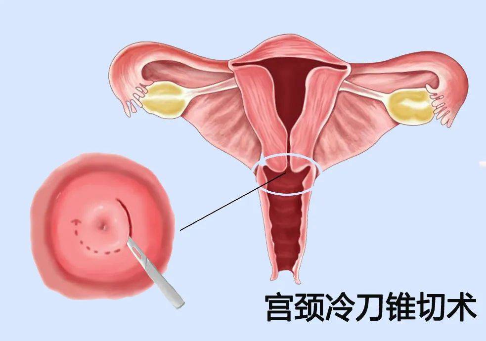 宫颈糜烂 电灼术图片