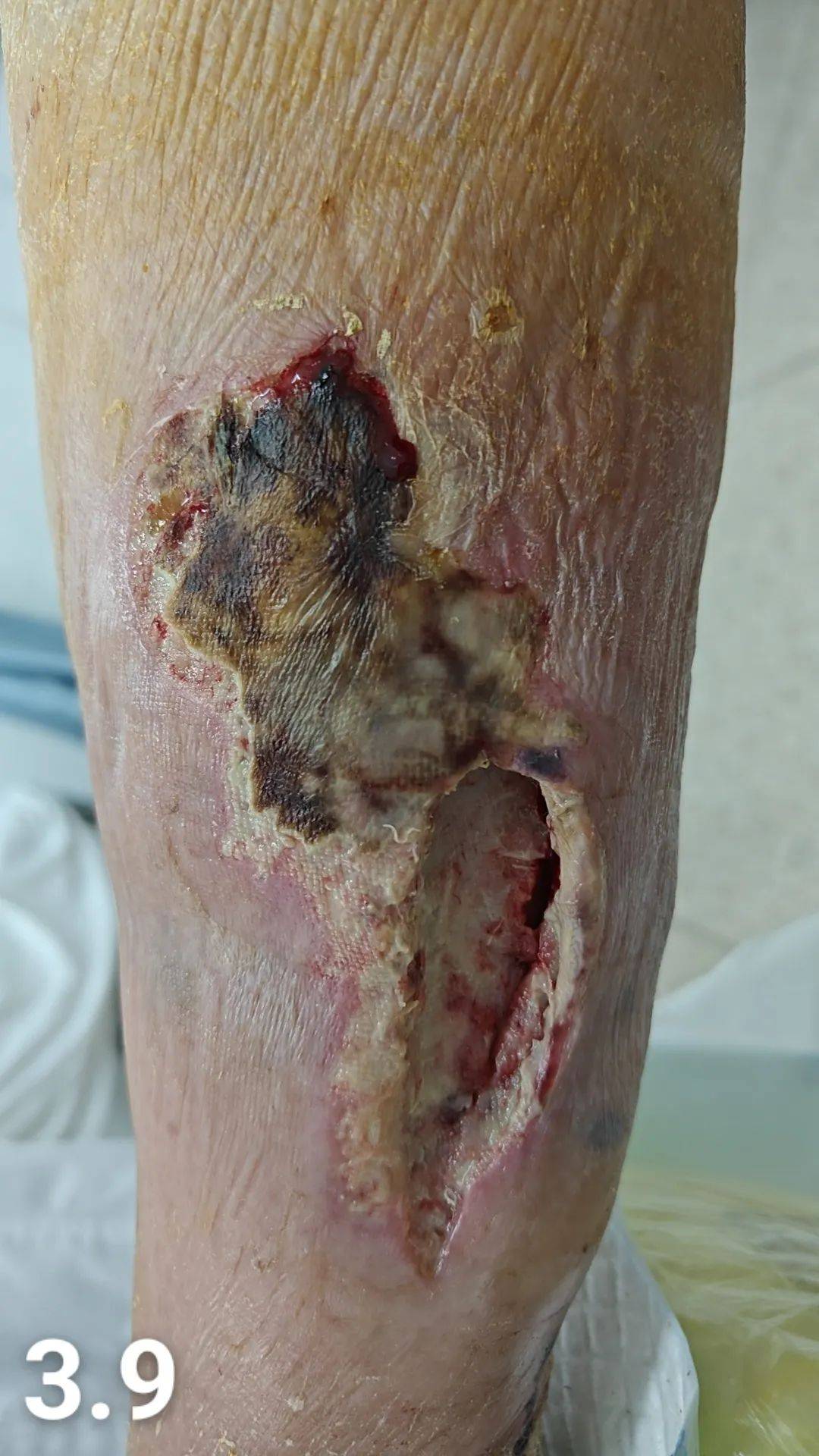 个体化治疗"老烂脚",揭西78岁阿婆逃过一"截"