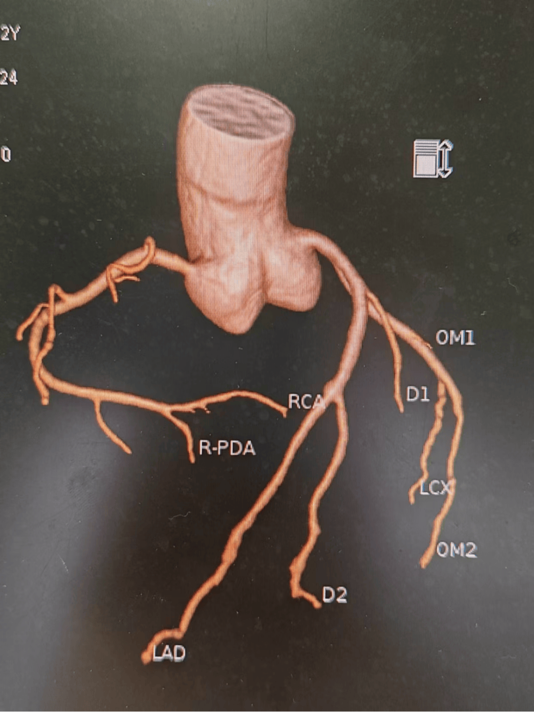 冠状动脉ct片子图片图片