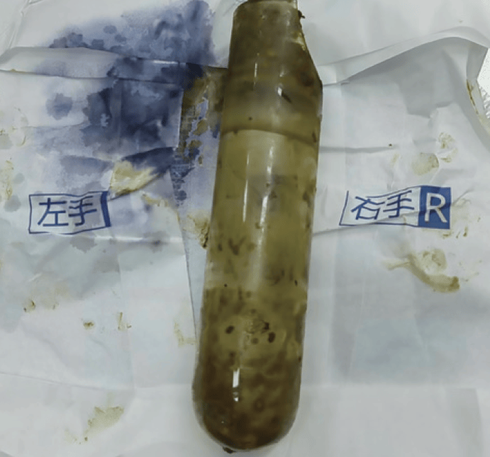 自创双球囊异物取出术治疗直肠内玻璃试管异物1例
