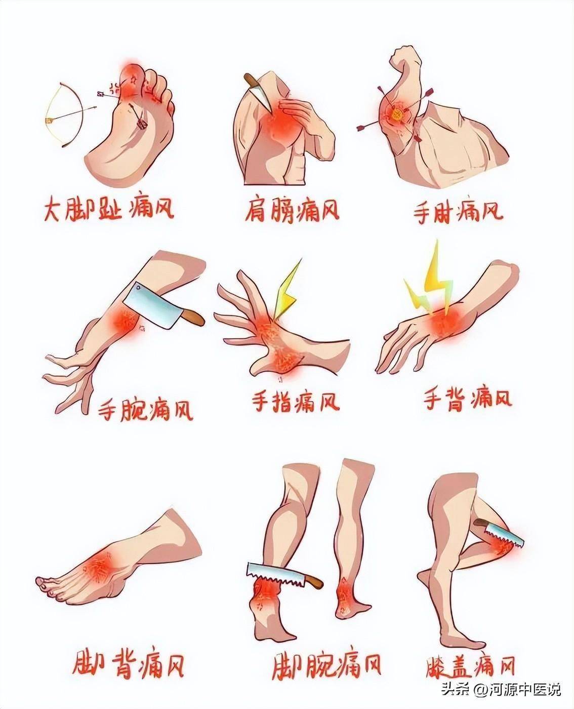 痛风是怎么形成的图片