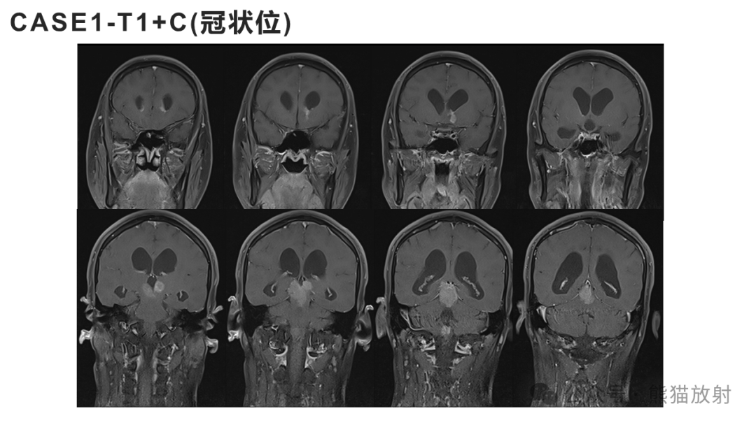 松果体占位图片