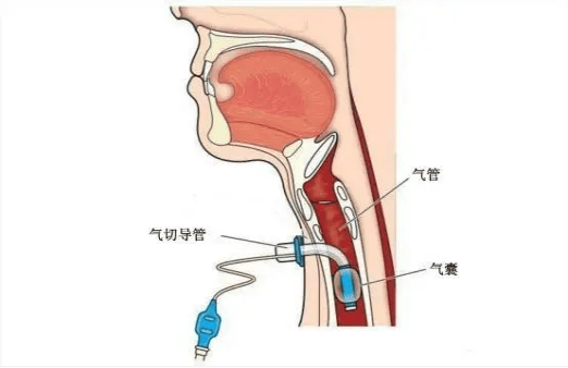 气管切开术步骤图解图片