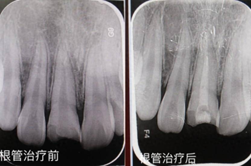 救救你的“门面担当”:外伤导致门牙受损的应对策略_牙齿_治疗_牙髓