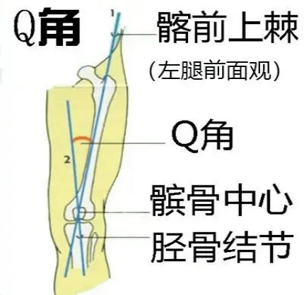 Q角异常?_髌骨_胫骨_夹角