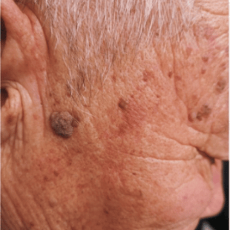 ，没有明显蒂状，那可能是另一种皮肤问题：脂溢性角化病，俗称老年疣。