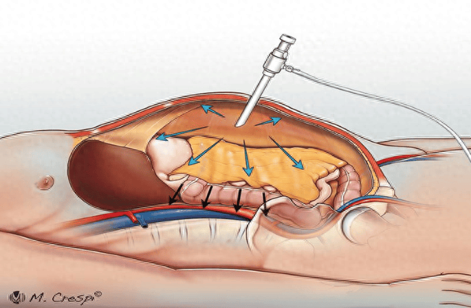 二氧化碳气腹对液体再分布的影响_碳酸_血量_血管