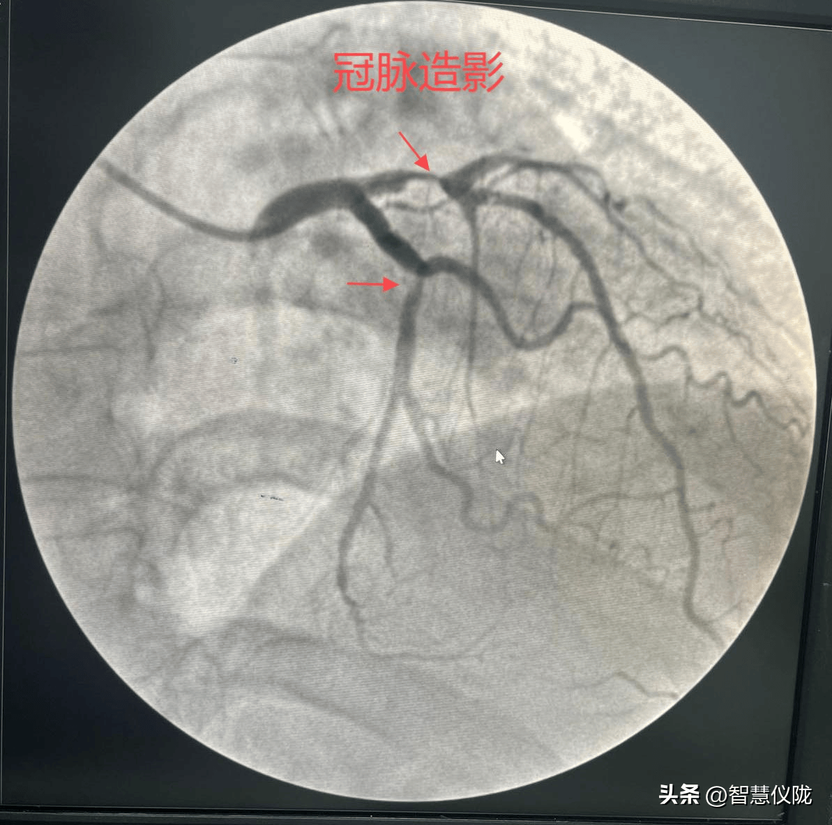 仪陇县总医院马鞍院区成功自主开展冠状动脉造影及支架植入术