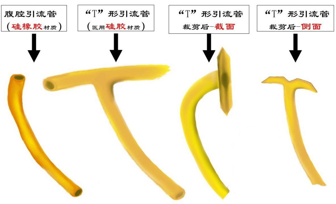 科普丨肝胆胰外科常用的T管,您了解多少_护理_胆管_患者