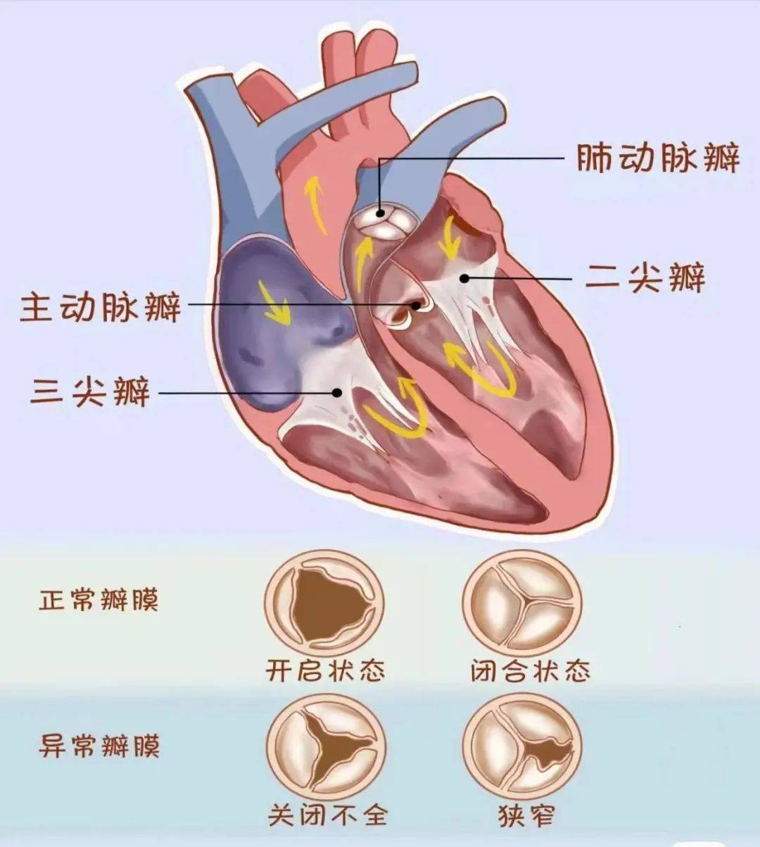 主动脉瓣是位于左心室和主动脉之间的"阀门",心脏收缩时会将左心室的