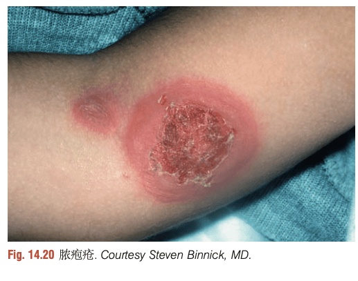 ① 细菌感染:如脓疱疮,蜂窝组织炎.