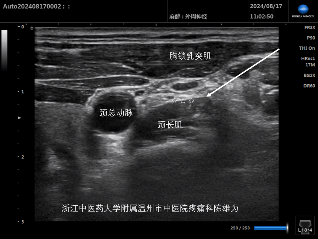 颈内动脉体表定位图片