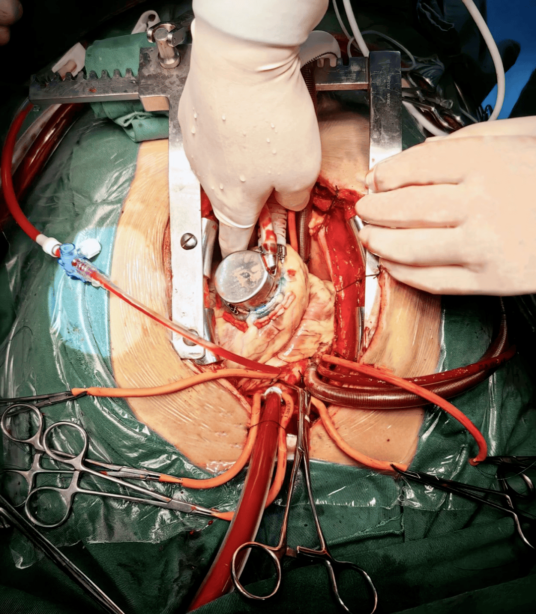 合肥高新心血管病医院梅举院长团队成功开展人工心脏