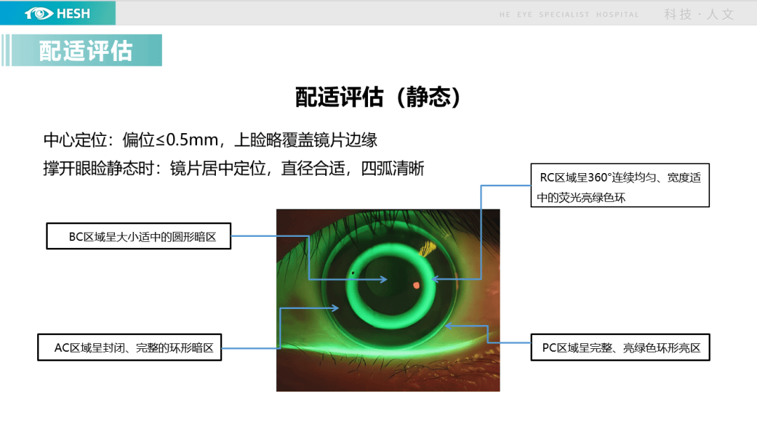 角膜塑形镜松紧配时图图片