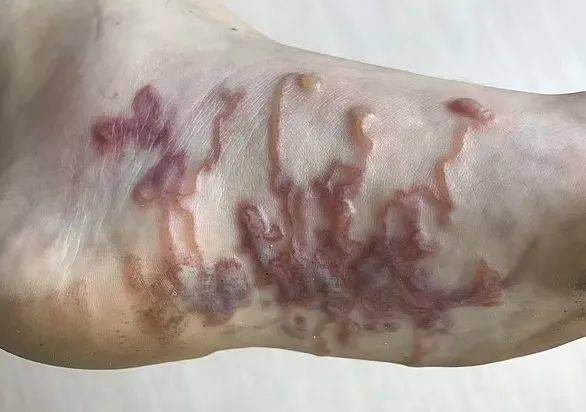 门诊来了一个 7 岁男孩,脚里有一根红色的线缠绕爬动