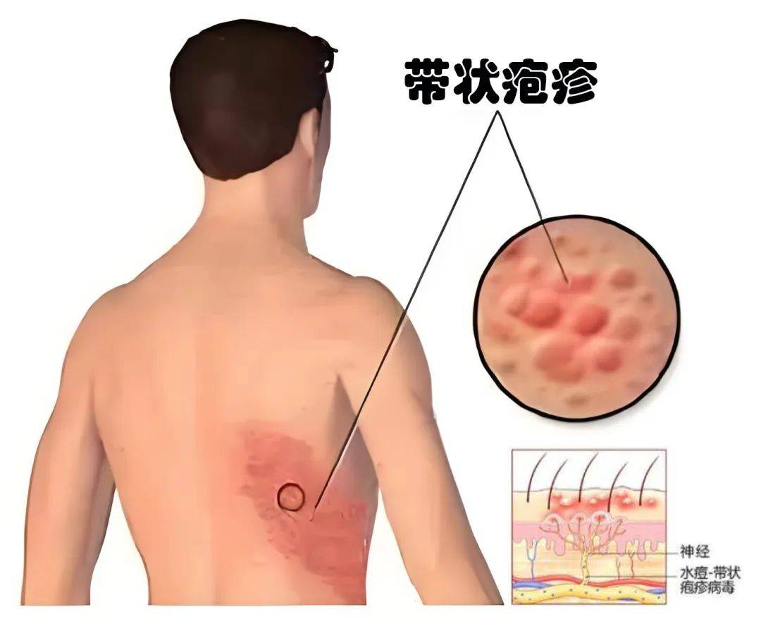 带状疱疹怎么治最好图片