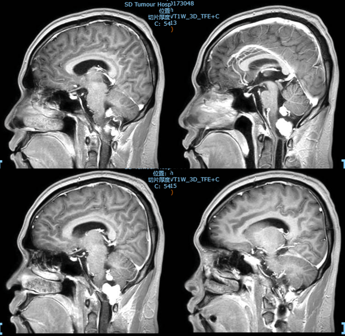 延髓瘤图片
